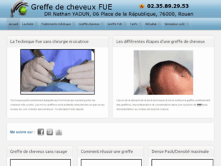 Détails : Greffe de cheveux en Rouen et sur Le Havre